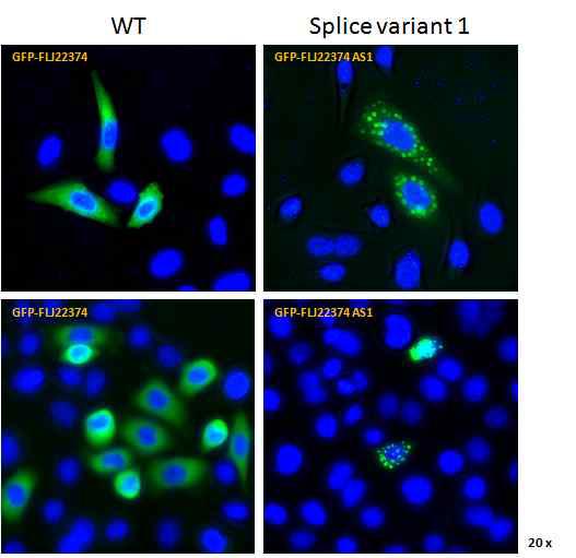 AGS stomach cancer cell line에 WT과 splice variant AS1을 over-expression시켰을 때 GFP로 tagging된 protein의 세포내 분포를 현미경하에서 관찰한 결과.