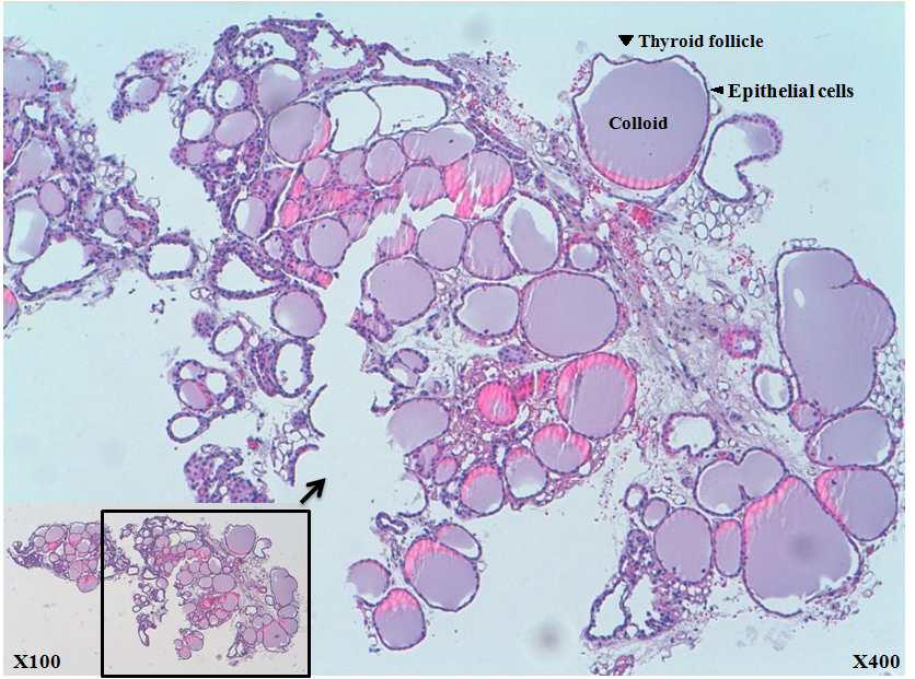 제거된 갑상선 H&E조직 염색.