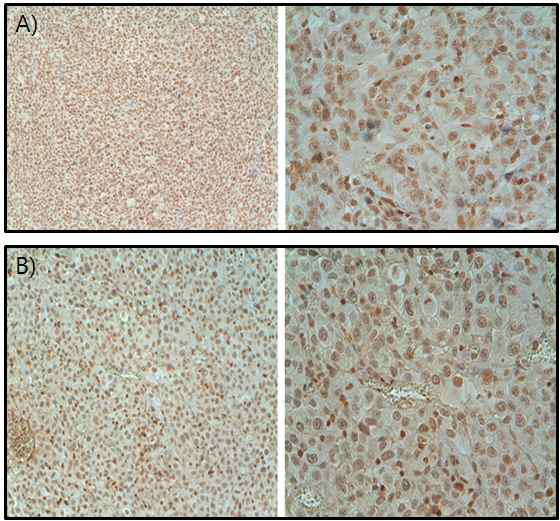 FTC133조직에서 NIS(Sodium iodide symporter) 조직염색.