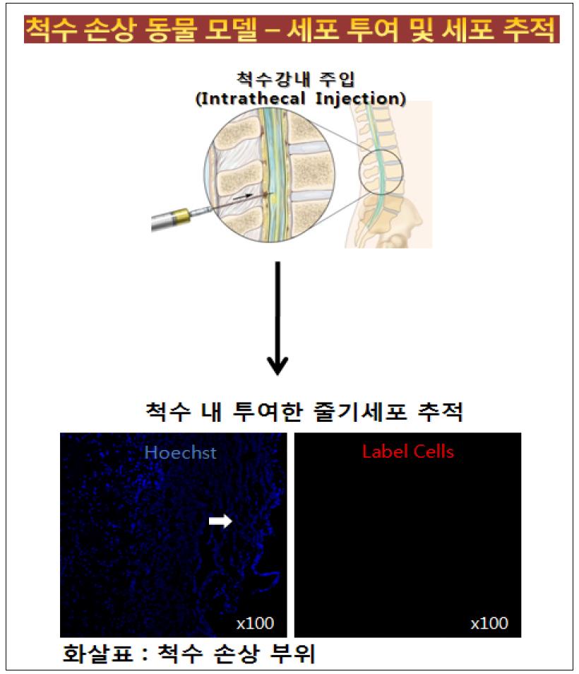 척수강내 줄기세포 투여