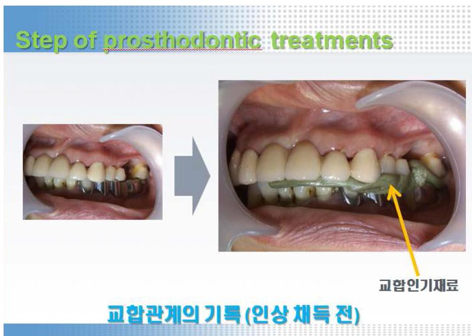 교합인기재의 사용방법 (교합상태 기록방법).