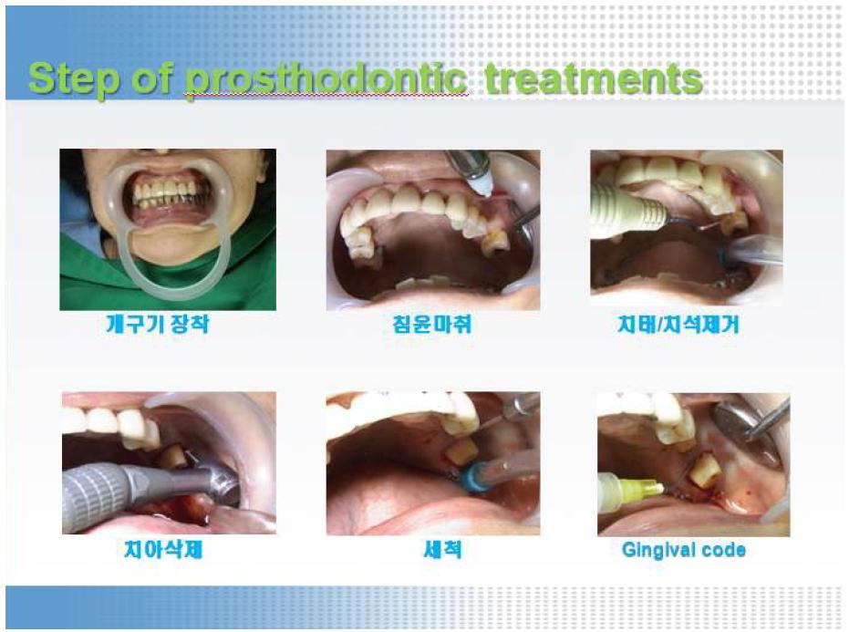 교합인기재의 사용방법 (치아의 삭제과정 및 인상채득준비).