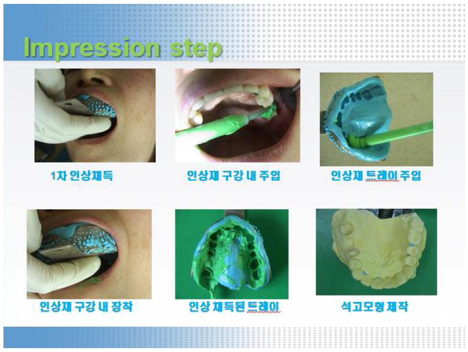 교합인기재의 사용방법 (치아삭제 후 인상채득 및 석고모형제작).