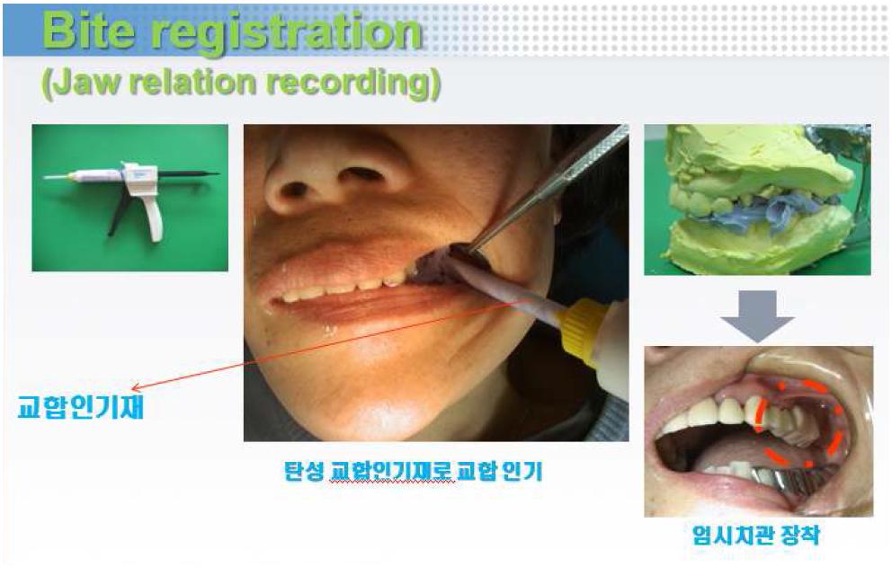 교합인기재의 사용방법 (최종 교합인기과정).