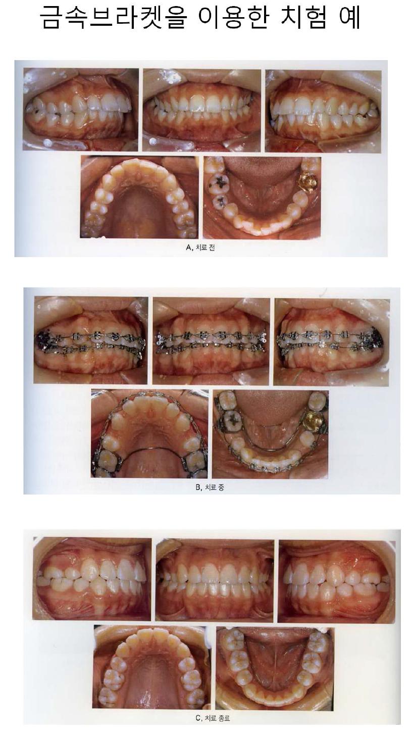 금속브라켓을 이용한 치료례;A. 치료전 B. 치료중 C. 치료종료.