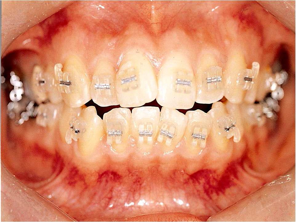 치아에 부착된 플라스틱 브라켓의 구강내 사진.