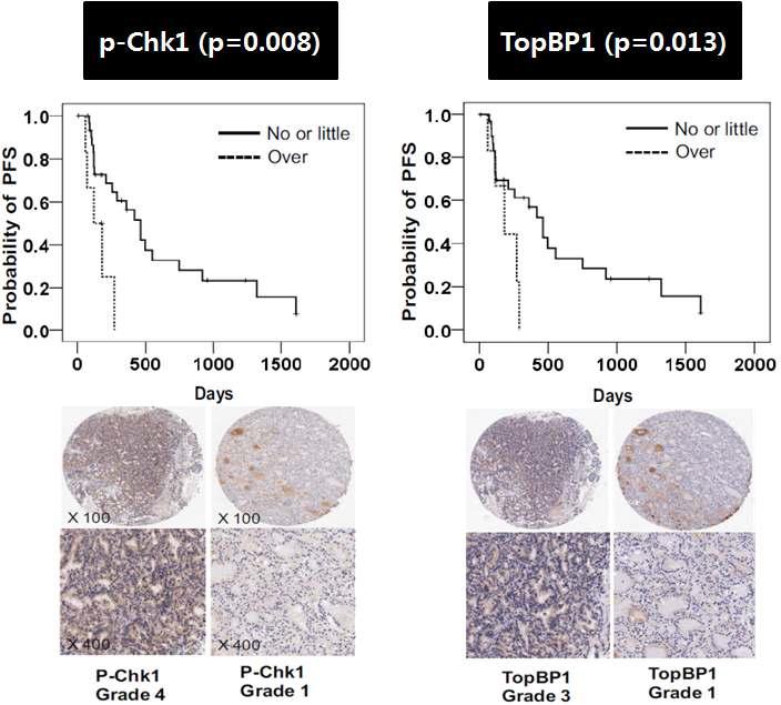 뇌전이 환자에서 p-Chk1과 TopBP1의 발현에 따른 환자의 PFS 비교.