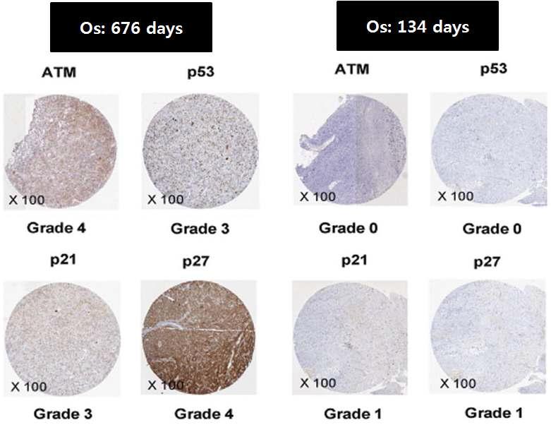 GBM 환자에서 ATM, p53, p21과 p21의 발현에 따른 환자의 PFS 비교.