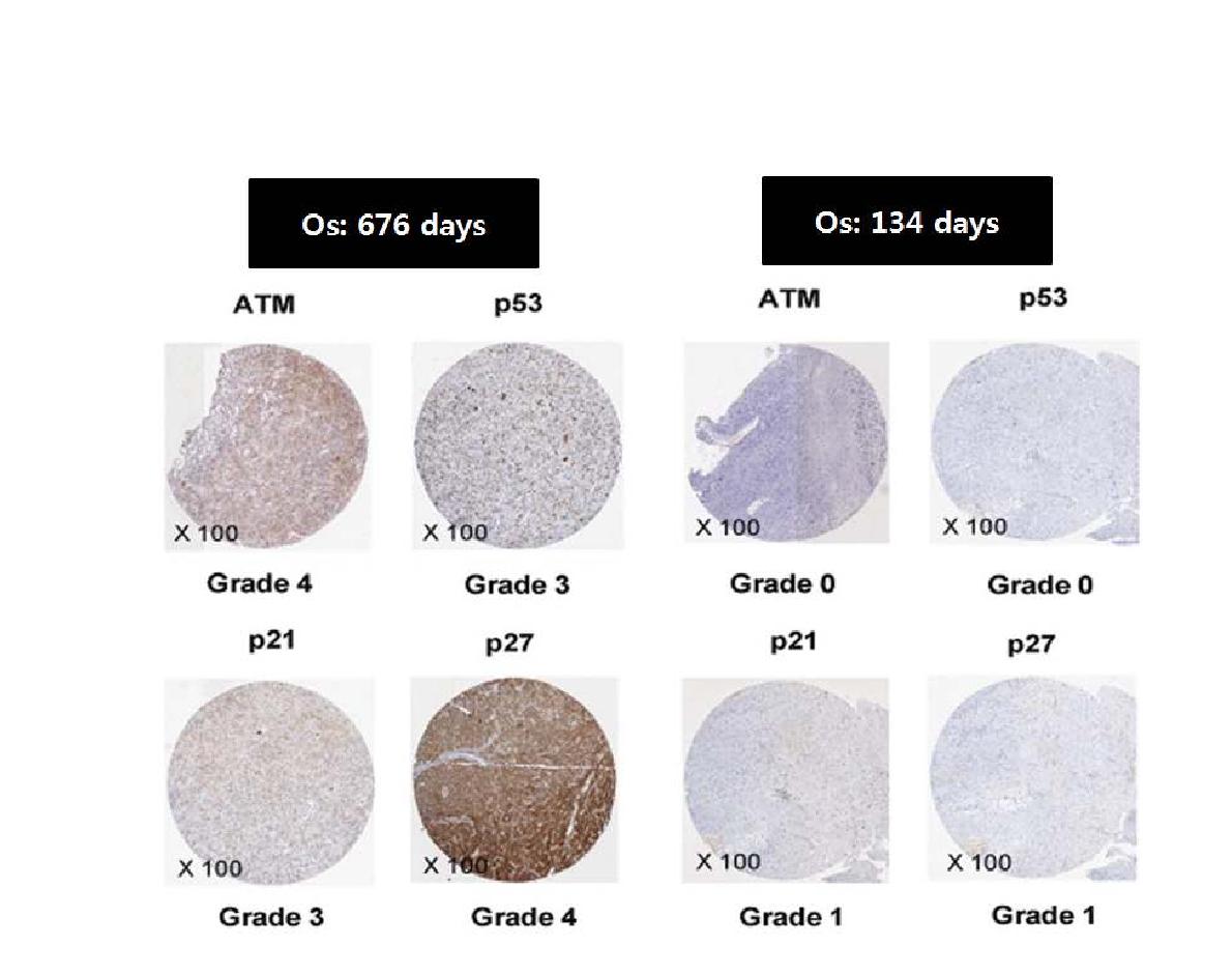 GBM 환자에서 ATM, p53, p21과 p21의 발현에 따른 환자의 PFS 비교.