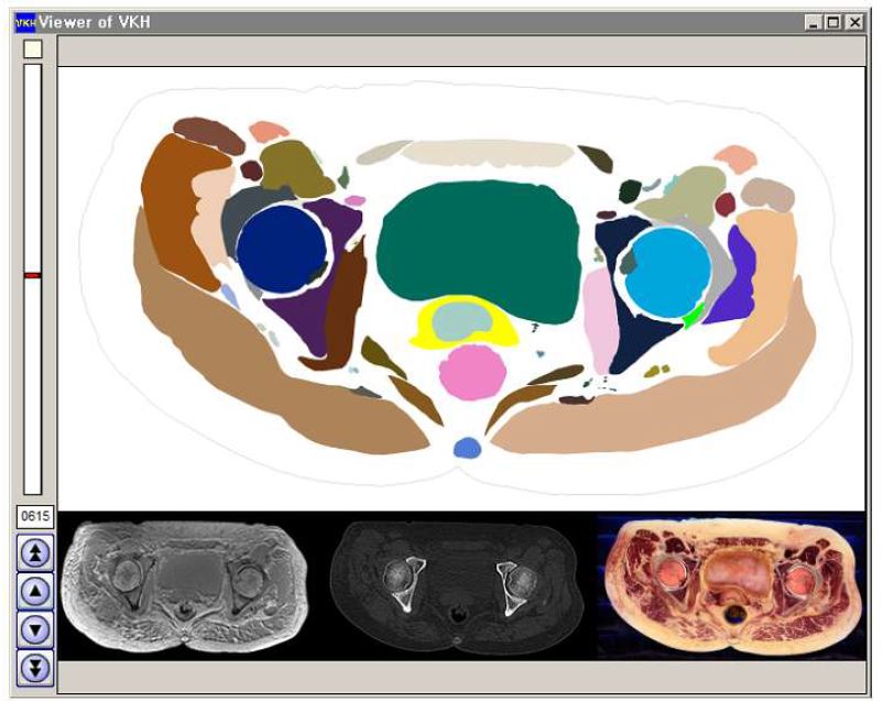 Viewer for sectioned and segmented images in Female Pelvis