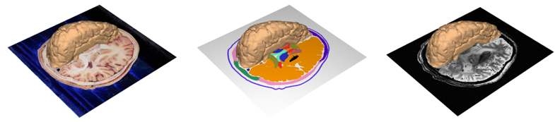 남성 머리의 표면3차원영상과 절단면영상(왼쪽), 구역화영상 (가운데), MR영상(오른쪽)을 겹쳐서 봄.
