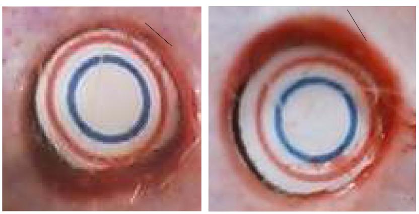 Macroscopic image of 5 day post wounding of full thickness 8mm surgical biopsy punch : Initial inflammation and epidermal regeneration observed.