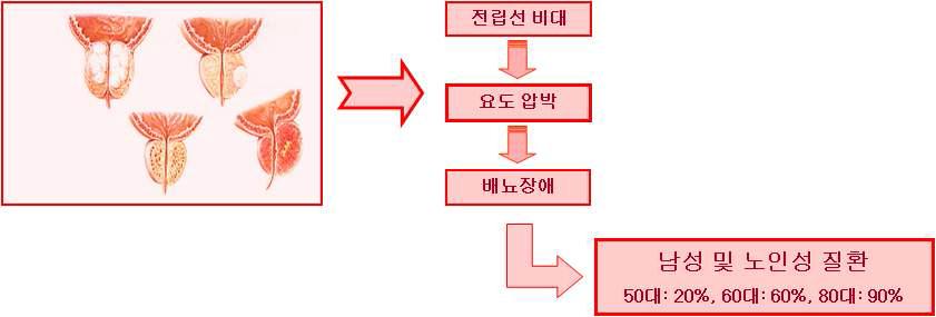 전립선비대증으로 인한 질환의 모식도