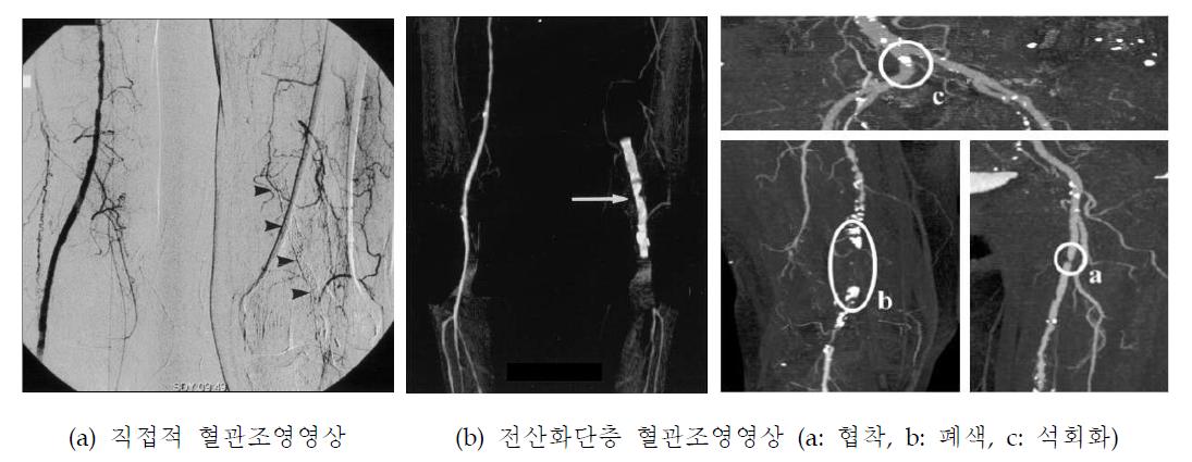 하지 동맥의 혈관조영영상과 전산화단층촬영 혈관조영영상