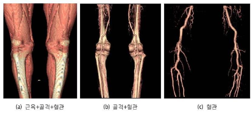 CTA 영상의 한계점 및 하지 동맥의 효과적 추출 가상 예