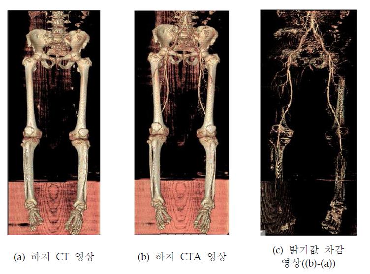 하지 CT-CTA 영상 간 밝기값 차감 영상 생성 예