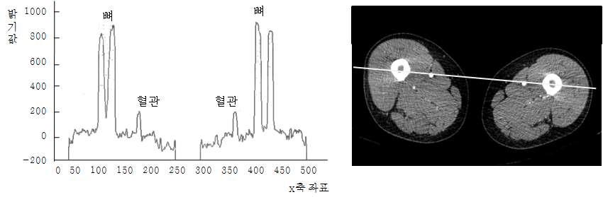 하지 CTA 영상에서 밝기값 분포