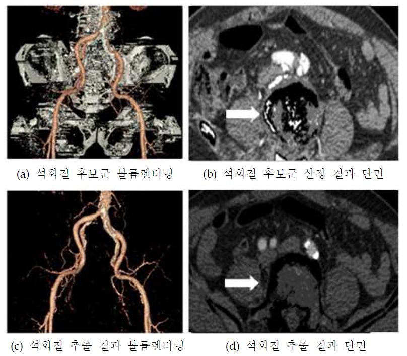 석회질 후보군 및 석회질 추출 과정