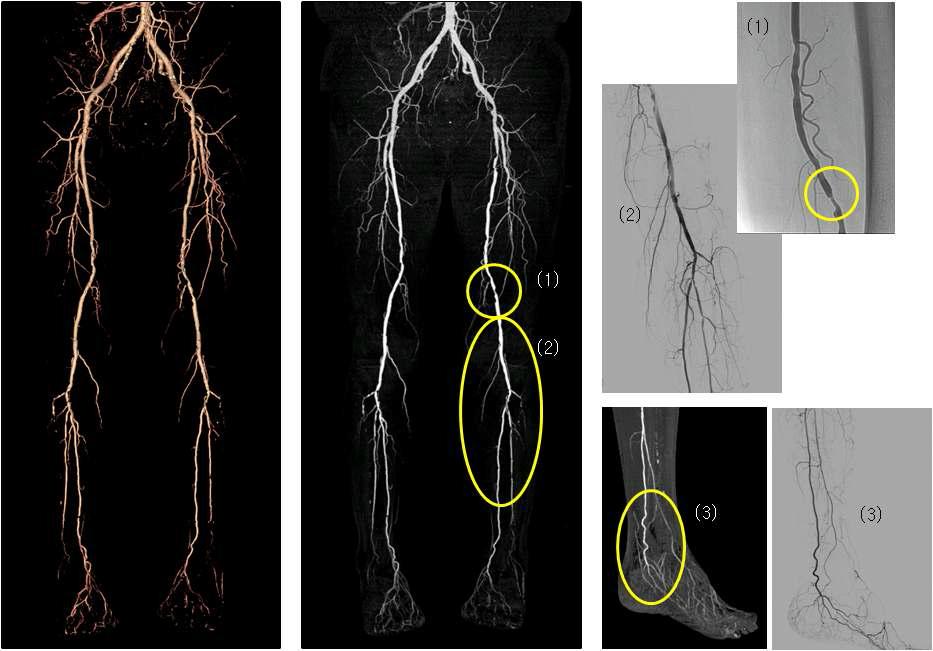 제안 방법을 적용한 하지 혈관 추출 결과(실험데이터1)