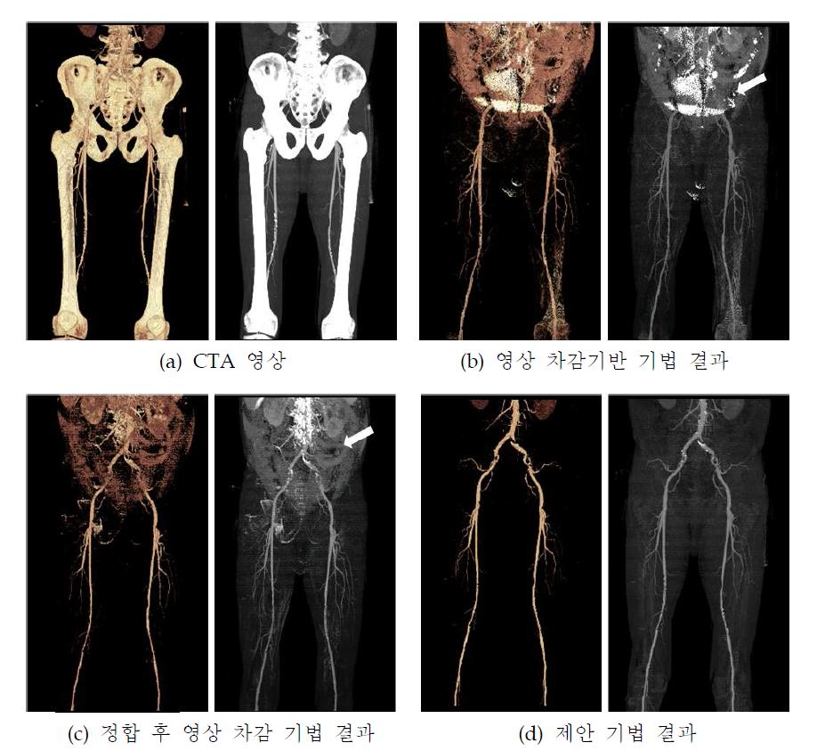 기존 연구와 제안 방법의 하지 혈관 자동 추출결과 비교