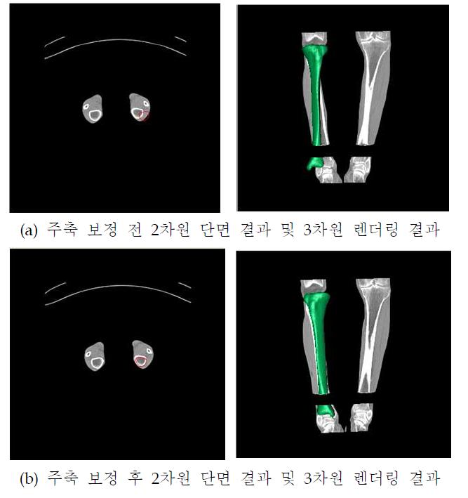 대퇴골 주축 보정 결과