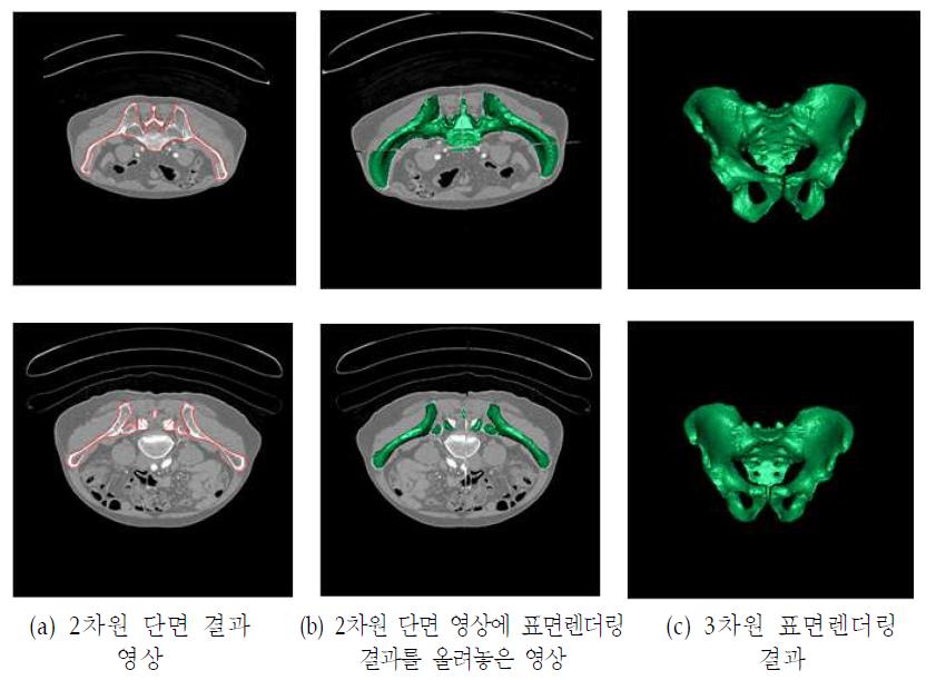 골반뼈 3차원 자동 분할 결과