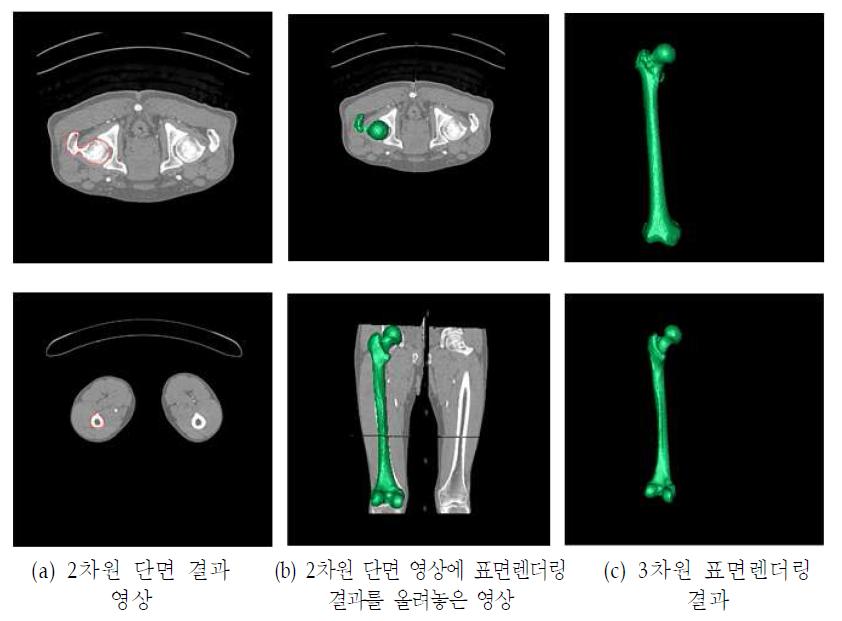 대퇴골 3차원 자동 분할 결과