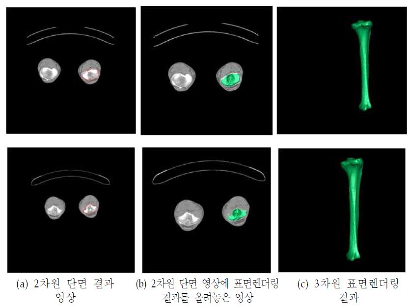 경골 3차원 자동 분할 결과