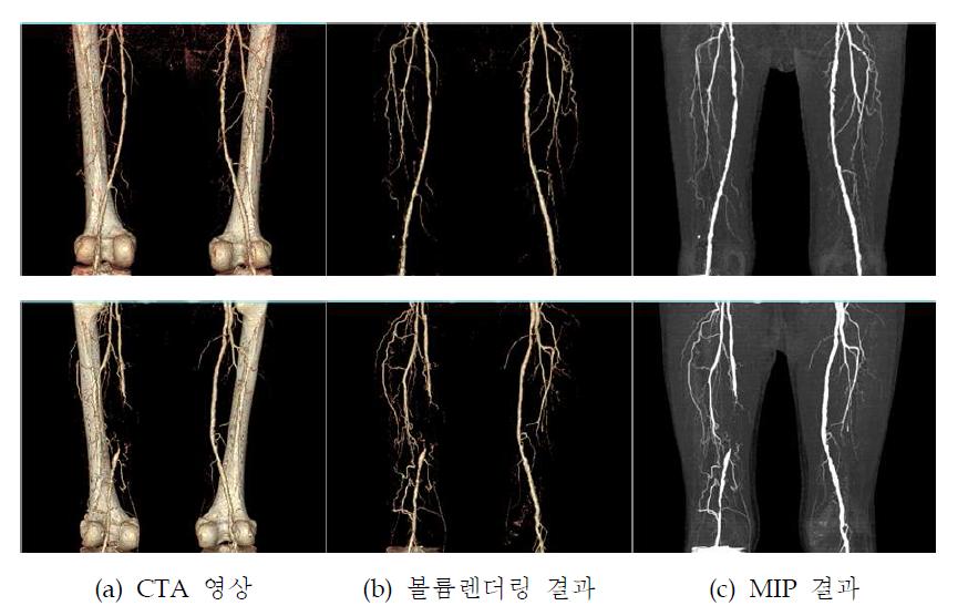 제안 방법을 적용한 대퇴골 영역 혈관 추출 결과