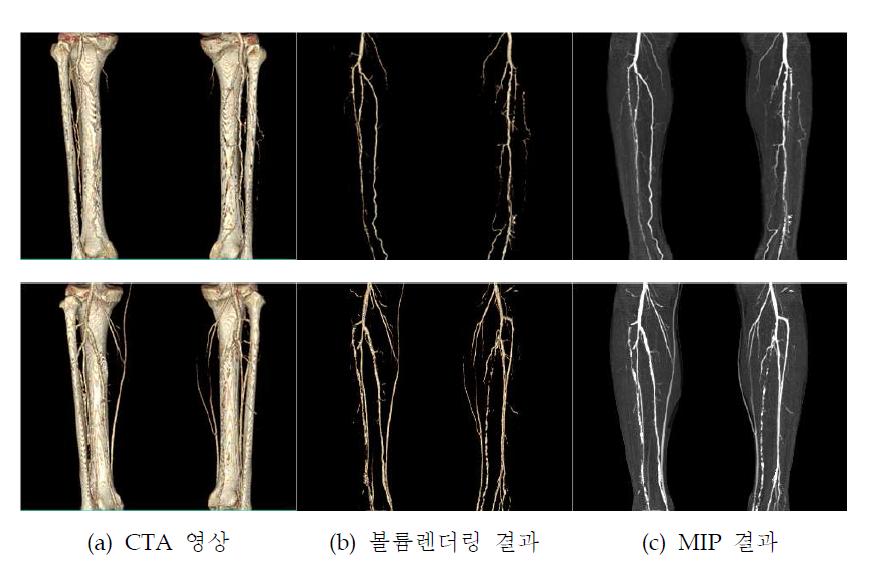 제안 방법을 적용한 경골 영역 혈관 추출 결과