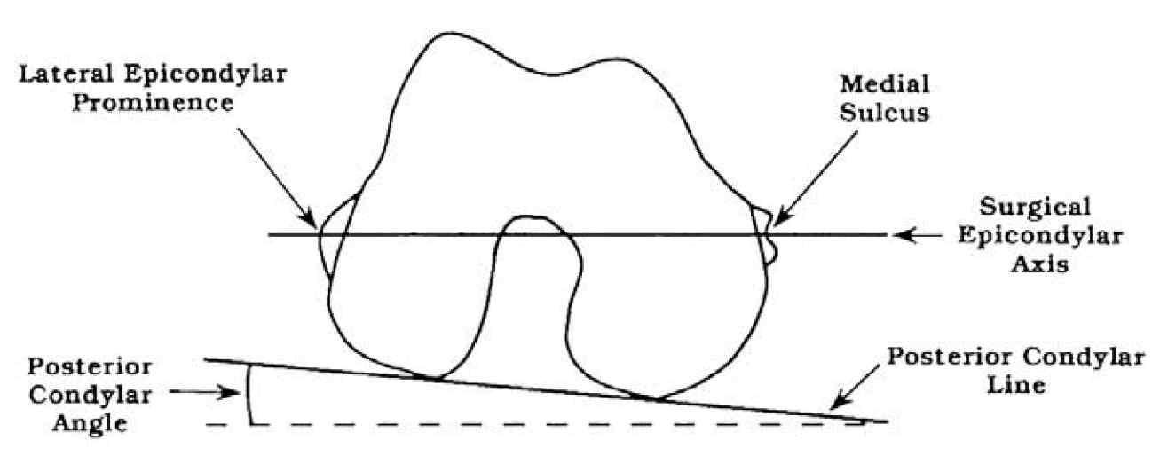 Diagram of the axial view of the right distal femur as seen from below by the surgeon during total knee arthroplasty with the knee flexed at 90°. The posterior condylar angle is the angle between the posterior condylar surfaces and the surgical epicondylar axis, defined by using the medial and lateral epicondyle. From: Berger RA, Rubash H, Seel M, Thompson W, Crossett L. Determining the rotational alignment of the femoral component in total knee arthroplasty using the epicondylar axis. Clin Orthop 1983;Jan(286): 40-7. Lippincott Williams & Wilkins. http://www.lww.com. Reprinted with permission.