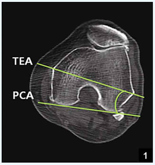 The degree of external torsion of the distal femur is defined as the angle between posterior condylar axis (PCA) and transepicondylar axis (TEA).