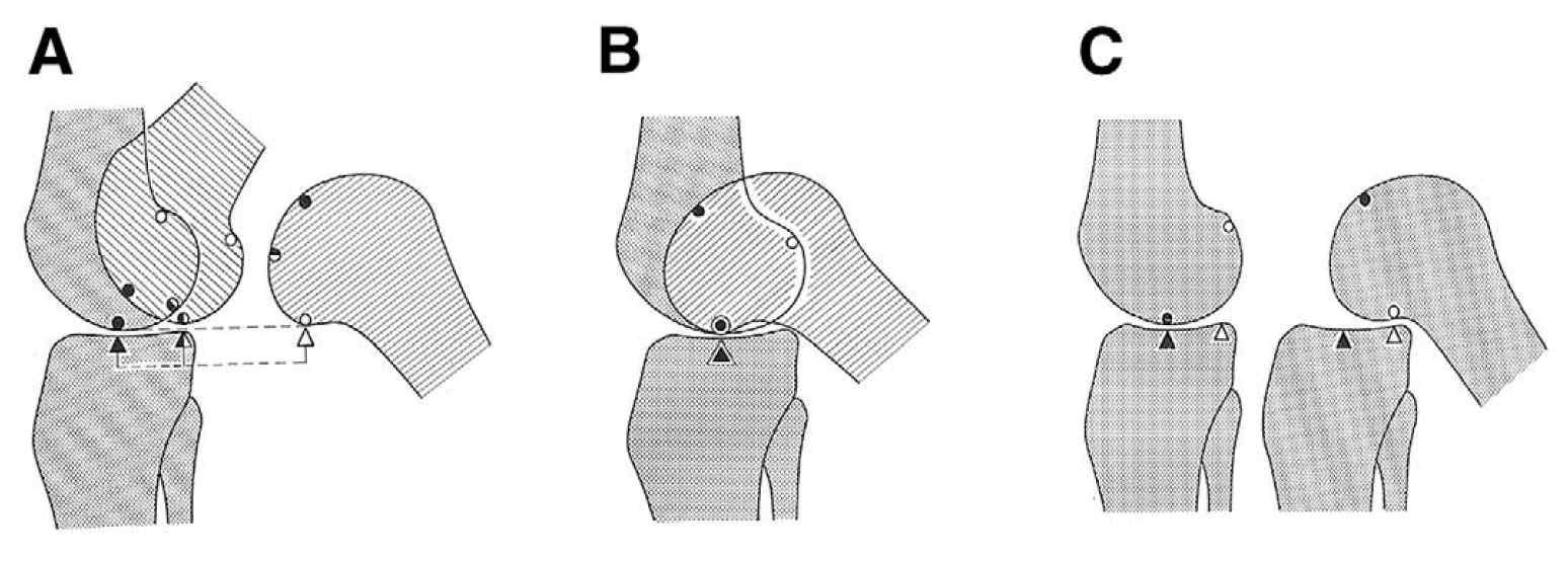 Roll and glide movements of the femoral condyle. (A) Pure rolling motion: the femur rolls off the tibial plateau before full flexion is complete. (B) Pure sliding motion: the femur impinges the posterior tibial plateau before full flexion is achieved. (C) Combined rolling and gliding of the femoral condyles allows full range of flexion. Reprinted with permission.