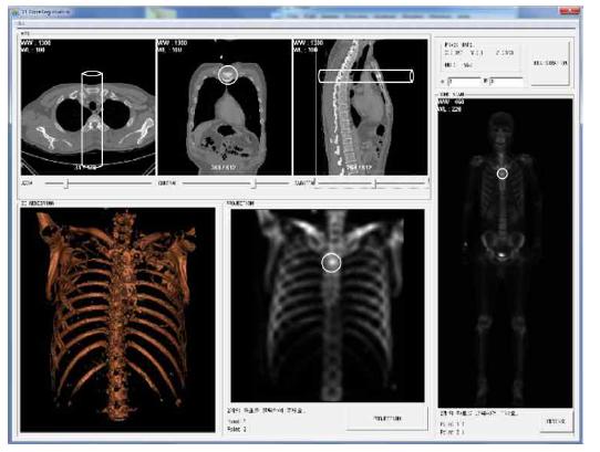 2차원 뼈 스캔과 3차원 CT 영상과의 연동 시스템