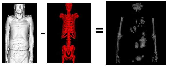 Fused 3D images of CT and PET