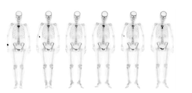 Successive bone scan. 가장 왼쪽이 기준(target)영상임.