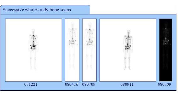 동일 환자의 뼈스캔 영상들