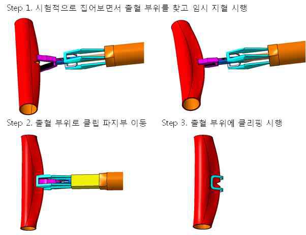 지혈 클립 장착 장치 4차 시제품의 작동 단계