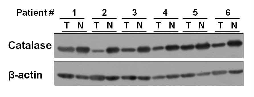 Tumor조직과 nontumor조직의 catalase protein level 을 분석