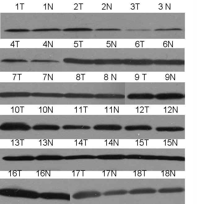 G1기의 tumor와 non-tumor의 catalase의 protein발현변화를 immunoblot analysis를 통해서 확인하였음.