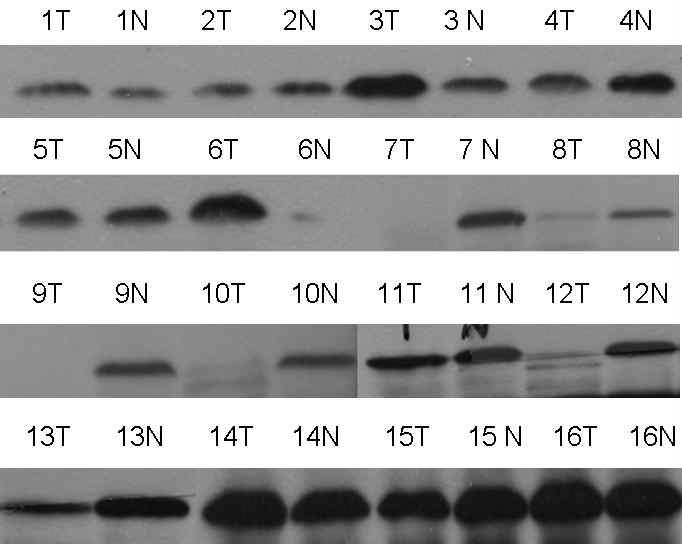 G2기의 tumor와 non-tumor의 catalase의 protein발현 변화를 immunoblot 을 통해서 확인하였음.