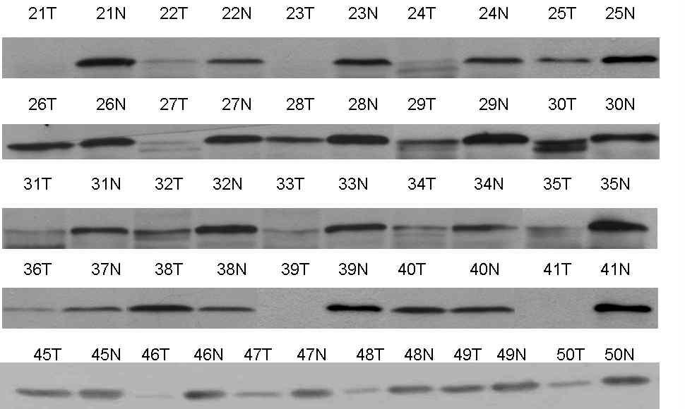 G3기의 tumor와 non-tumor의 catalase의 protein발현 변화를 immunoblot analysis를 통해서 확인하였음.