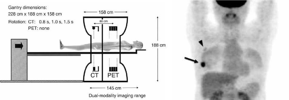 PET/CT 스캐너(좌)와 유방암 환자에서의 FDG PET 영상(우) (Townsend et al., 2004; 이원형, 유이령, 2007)