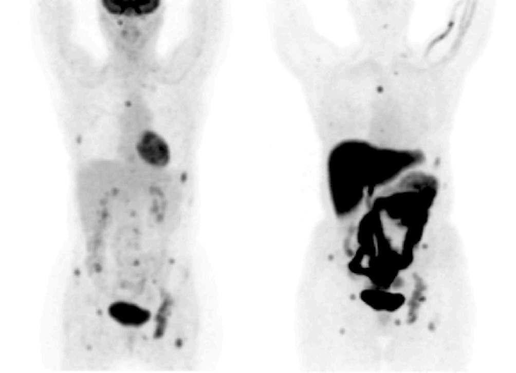 유방암 환자에서 FDG PET(좌)과 에스트로겐 수용체용 FES PET 영상(우) (Benard and Turcotte, 2006)
