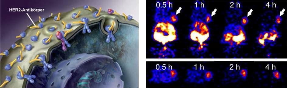 유방암 세포에서 HER2(Human epidermal growth factor receptor type 2) 수용체 발현과 마우스 모델에서 18F-FBO-ZHER2:477 PET 영상(Cheng et al., 2008)