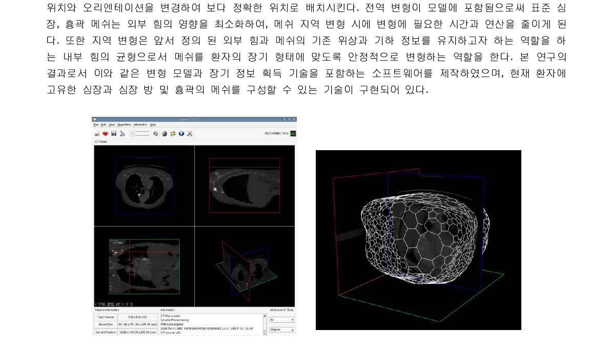 – 통합 소프트웨어 및 흉곽 변형 결과