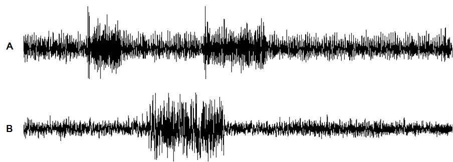 FeCl3로 유도한 난치성 간질 마우스 모델의 대뇌 피질을 전기생리학적 기술을 이용하여 측정한 local field potential. 이 그림에서는 2마리의 난치성 간질 마우스에서 유사하게 반복적으로 spontaneous 간질성 발작이 나오는 것을 볼 수 있음