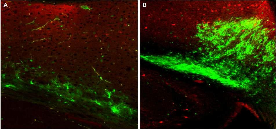 난치성 간질 마우스 모델에 GFP-MGE progenitor cell(green)을 이식한 것으로, 대뇌 피질의 PV(red)와 함께 staining 한 것으로 이식한 세포들의 형태적 분화양상을 볼 수 있음.