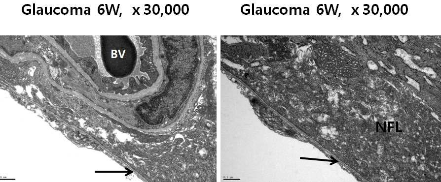 Electron microphotographs taken from a part of glaucomatous retinas. BV, blood vessel in the nerve fiber layer (NFL), arrows, internal limiting membrane of the retina,