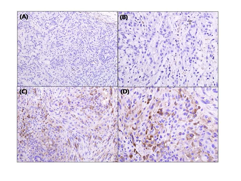 Immunohistochemical staining for HSTK in tumor mass treated with ad-HSTK or ad-HSTK + 24RGD.